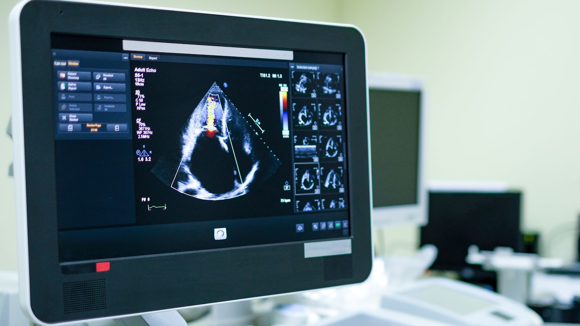 Intelligent Ultrasound has sold its clinical AI business to GE HealthCare